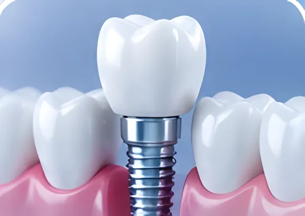 Implantes dentários